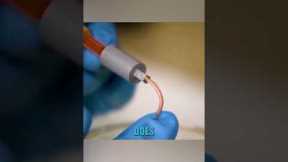 Gallium needle that doesn’t hurt